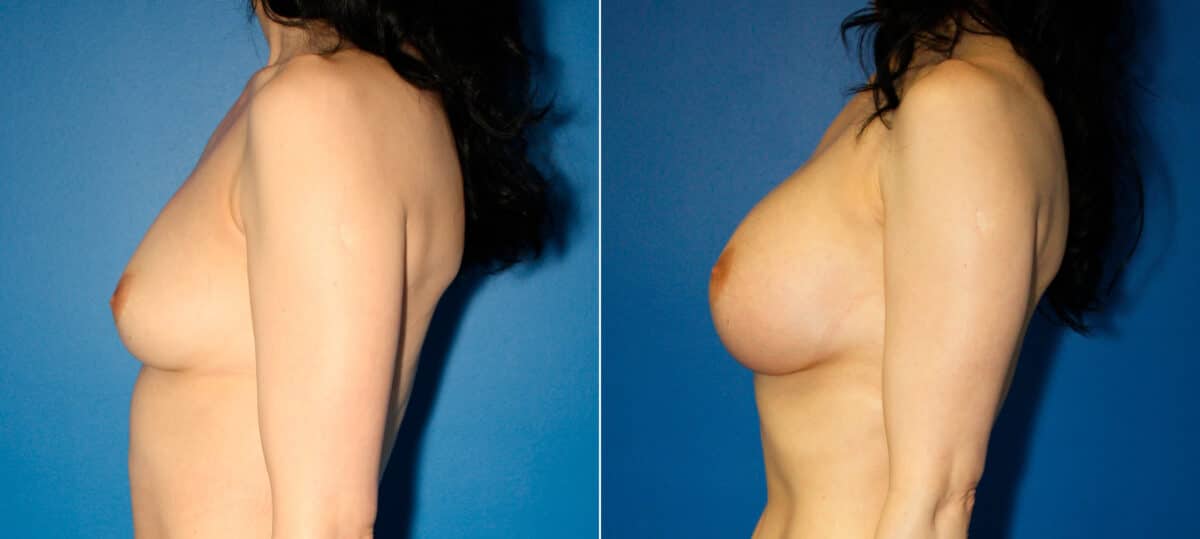 Breast Augmentation Before and After Photos in New York, NY, Patient 15449
