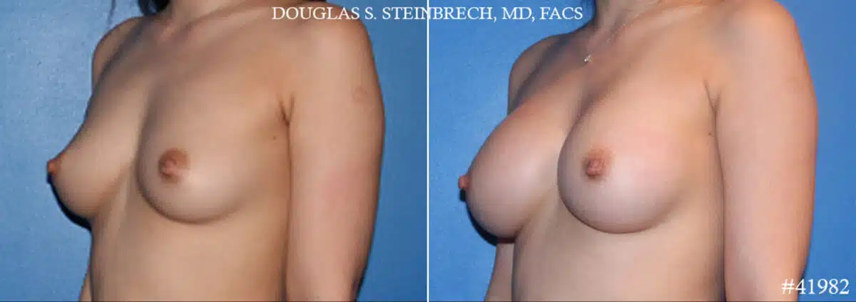 Breast Augmentation Before and After Photos in CA, Beverly Hills, Patient 19156