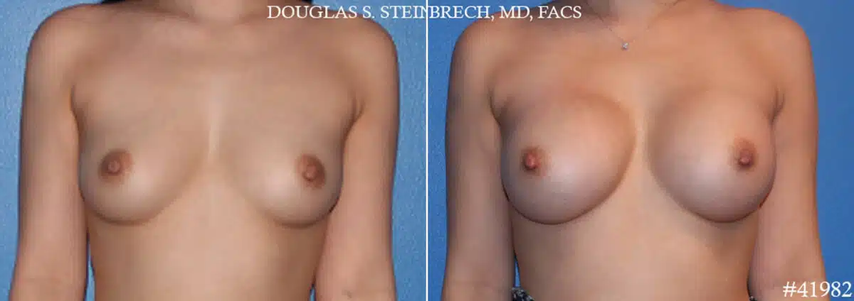 Breast Augmentation Before and After Photos in CA, Beverly Hills, Patient 19156
