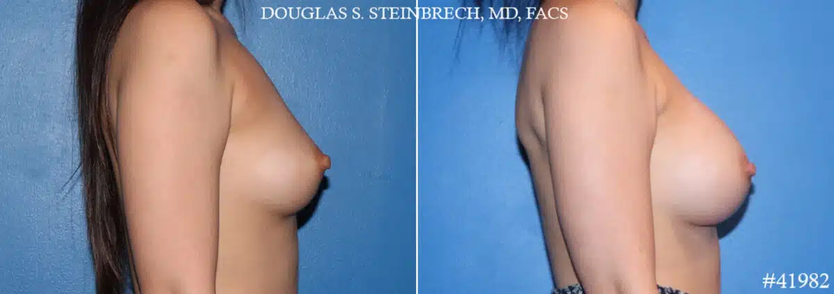 Breast Augmentation Before and After Photos in CA, Beverly Hills, Patient 19156