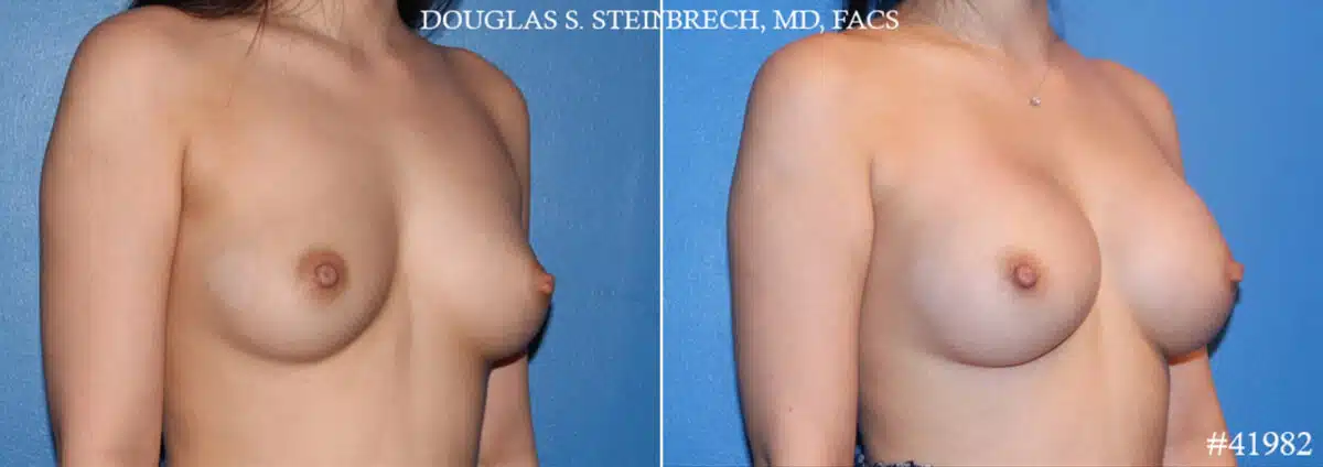 Breast Augmentation Before and After Photos in CA, Beverly Hills, Patient 19156