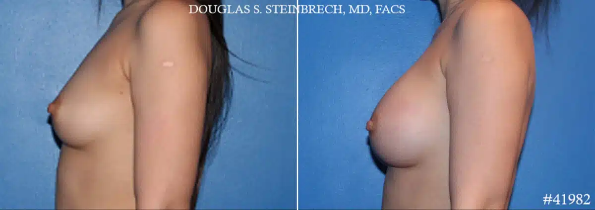 Breast Augmentation Before and After Photos in CA, Beverly Hills, Patient 19156