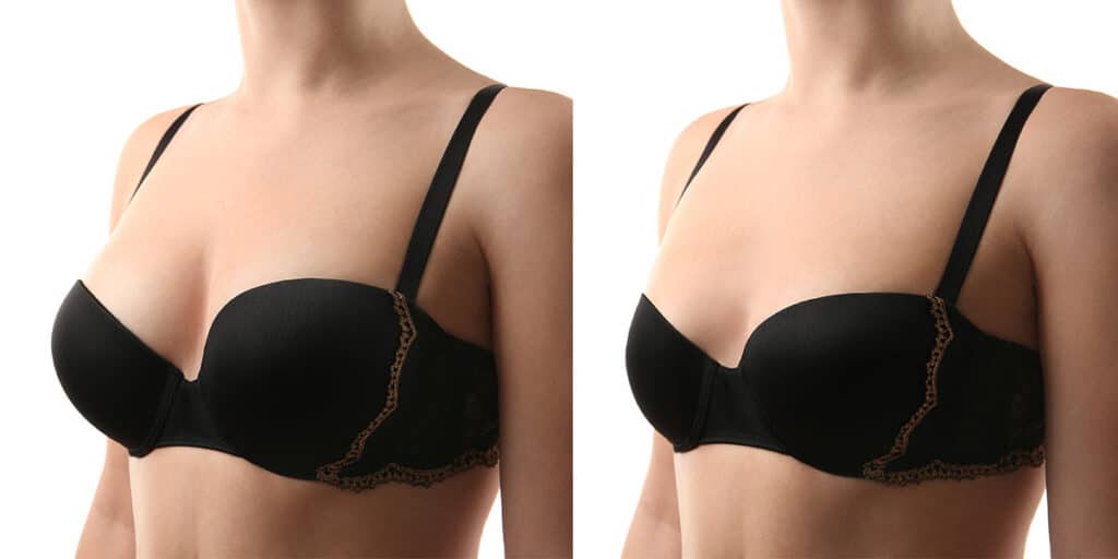 Female patient before and after a breast reduction procedure in New York.