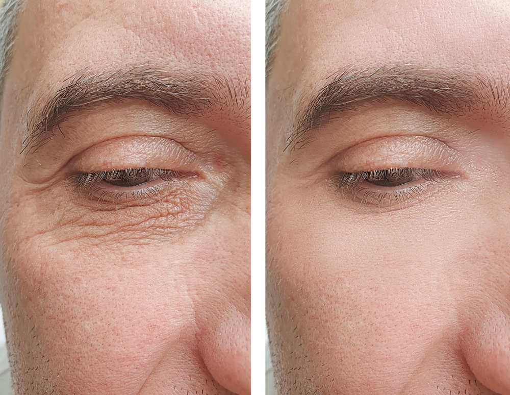 Before and after close-up of male eye area showing reduced wrinkles and under-eye bags after eyelid surgery.
