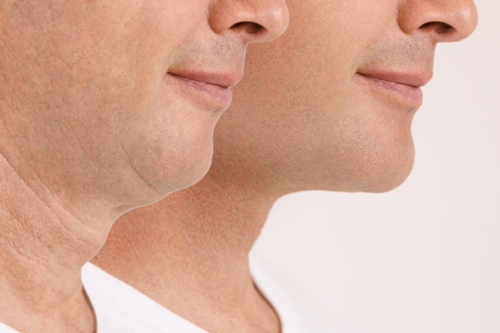 Side-by-side comparison of male jawline before and after liposuction showing reduced double chin and tighter profile.