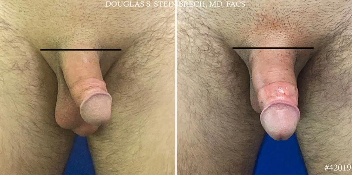 Patient 24683, Male Enhancement Before and After Photos Male Enhancement Before and After Photos in CA, Beverly Hills, Patient 24683
