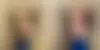 Male Enhancement Before and After Photos in CA, Beverly Hills, Patient 24683