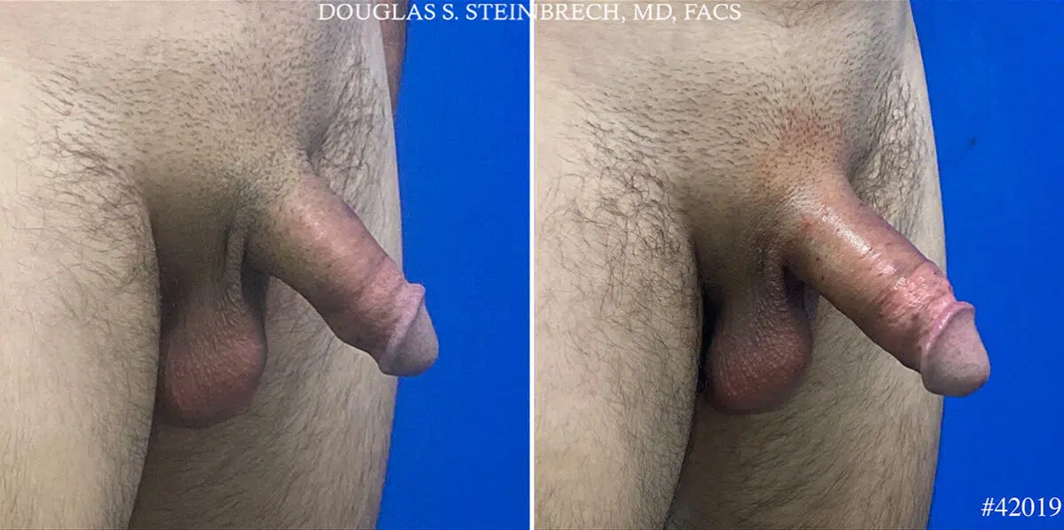 Patient 24683, Male Enhancement Before and After Photos Male Enhancement Before and After Photos in CA, Beverly Hills, Patient 24683