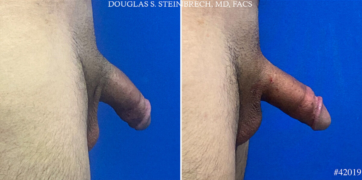 Patient 24683, Male Enhancement Before and After Photos Male Enhancement Before and After Photos in CA, Beverly Hills, Patient 24683