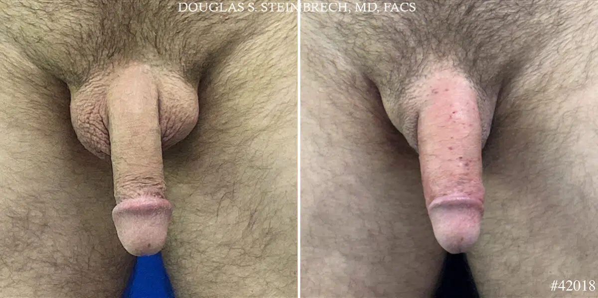 Patient 24705, Male Enhancement Before and After Photos Male Enhancement Before and After Photos in CA, Beverly Hills, Patient 24705