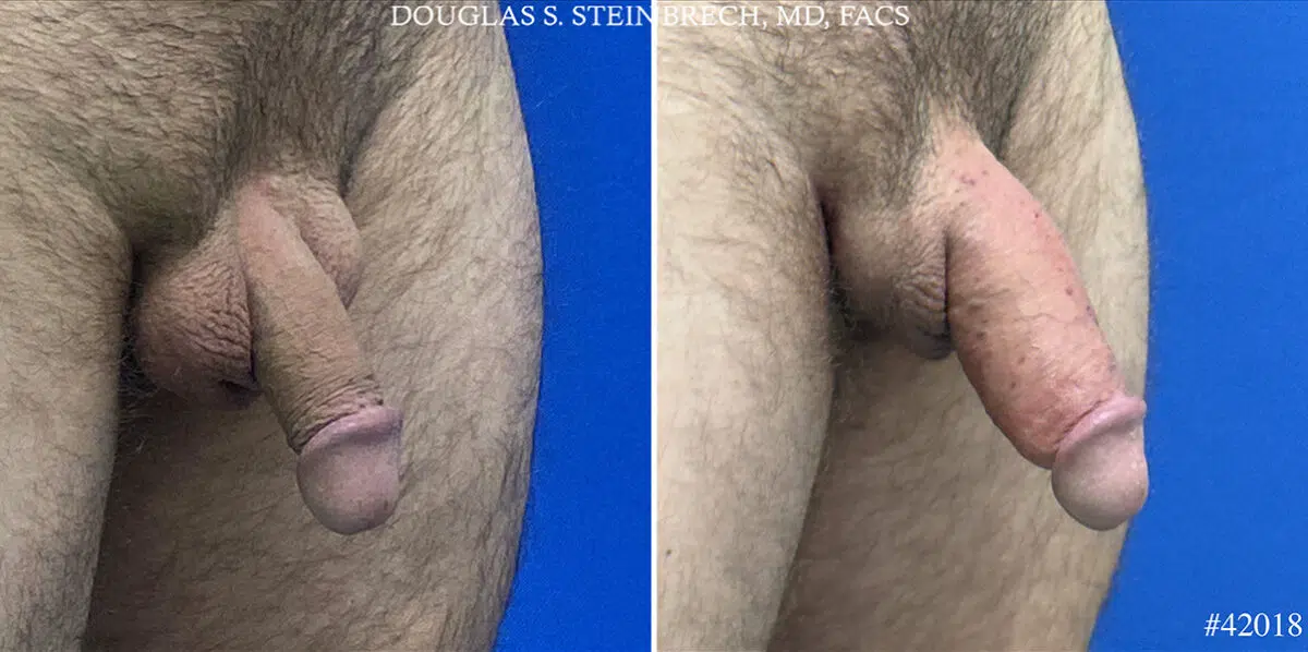 Patient 24705, Male Enhancement Before and After Photos Male Enhancement Before and After Photos in CA, Beverly Hills, Patient 24705