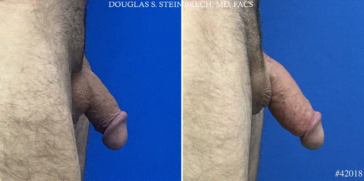 Patient 24705, Male Enhancement Before and After Photos Male Enhancement Before and After Photos in CA, Beverly Hills, Patient 24705
