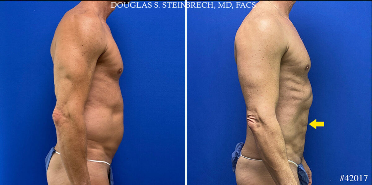 Patient 24785, Body Banking Before and After Photos Body Banking Before and After Photos in CA, Beverly Hills, Patient 24785