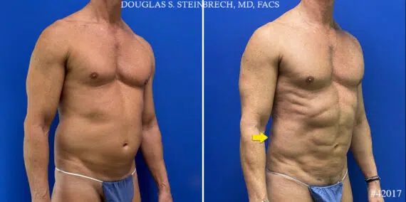 Body Banking Before and After Photos in CA, Beverly Hills, Patient 24785