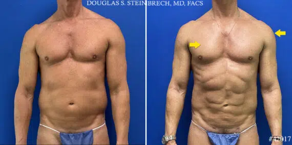 Body Banking Before and After Photos in CA, Beverly Hills, Patient 24785
