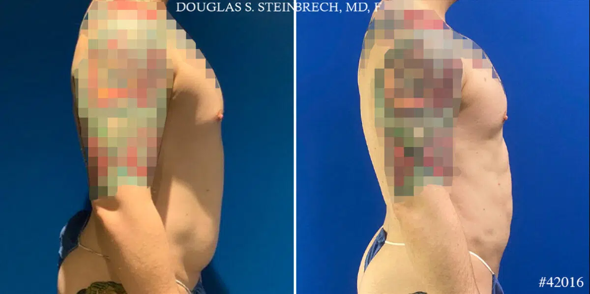 Body Banking Before and After Photos in CA, Beverly Hills, Patient 24802