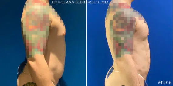 Body Banking Before and After Photos in CA, Beverly Hills, Patient 24802