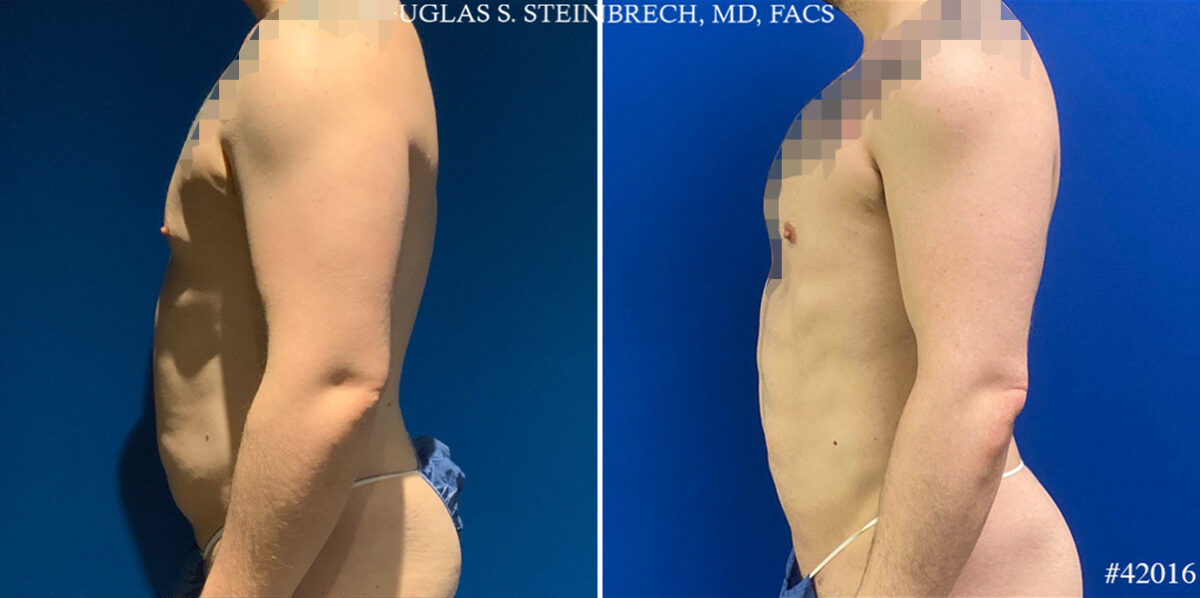 Body Banking Before and After Photos in CA, Beverly Hills, Patient 24802