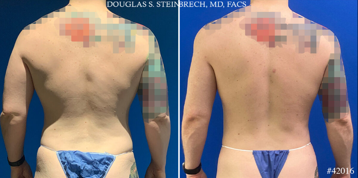 Body Banking Before and After Photos in CA, Beverly Hills, Patient 24802