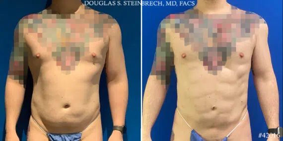 Body Banking Before and After Photos in CA, Beverly Hills, Patient 24802