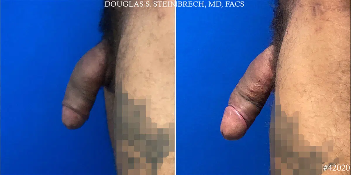 Patient 24815, Male Enhancement Before and After Photos Male Enhancement Before and After Photos in CA, Beverly Hills, Patient 24815