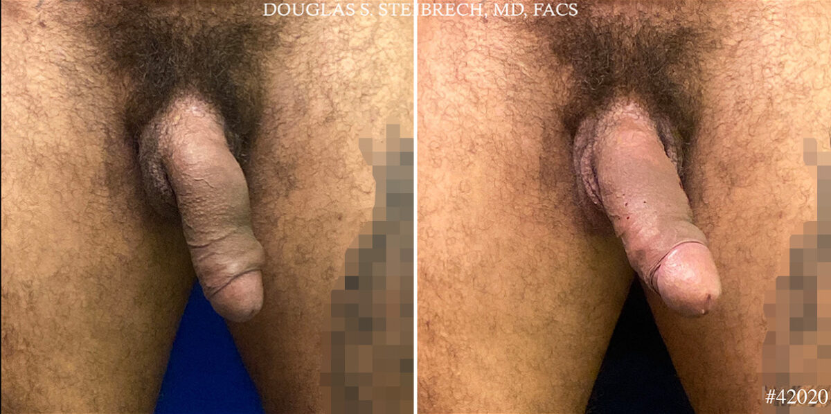 Patient 24815, Male Enhancement Before and After Photos Male Enhancement Before and After Photos in CA, Beverly Hills, Patient 24815