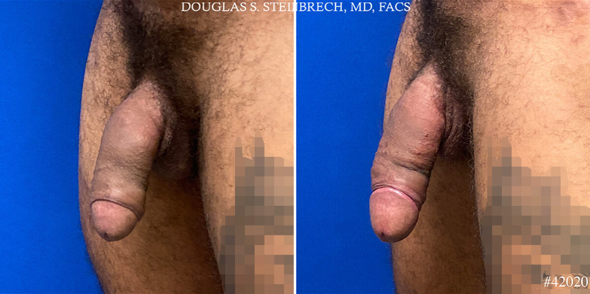 Patient 24815, Male Enhancement Before and After Photos Male Enhancement Before and After Photos in CA, Beverly Hills, Patient 24815