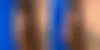 Male Enhancement Before and After Photos in CA, Beverly Hills, Patient 24815
