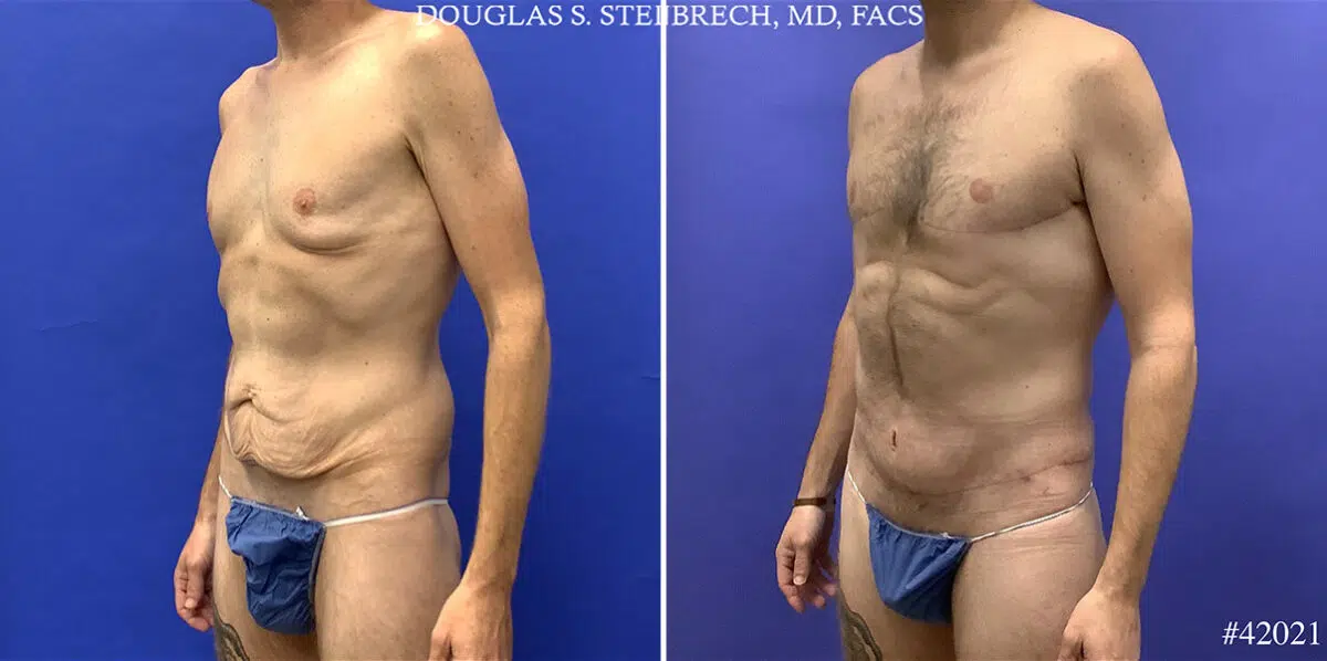 Patient 24833, Torso Tuck Before and After Photos Torso Tuck Before and After Photos in CA, Beverly Hills, Patient 24833