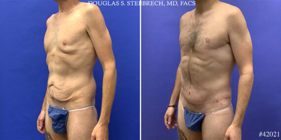 Chest Lift Before and After Photos in CA, Beverly Hills, Patient 24833