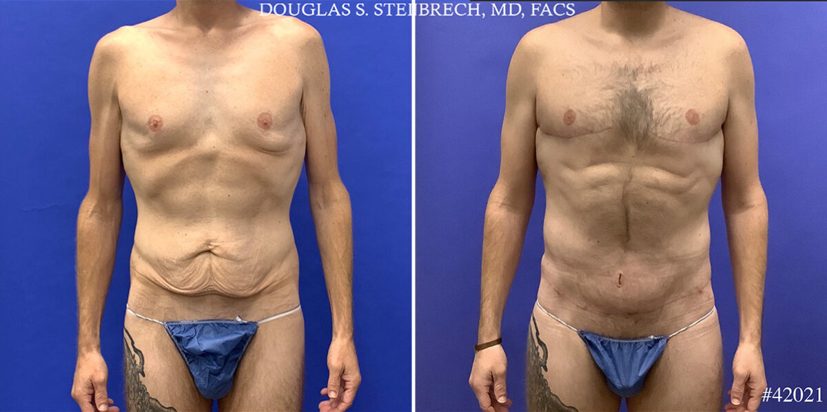 Patient 24833, Torso Tuck Before and After Photos Torso Tuck Before and After Photos in CA, Beverly Hills, Patient 24833