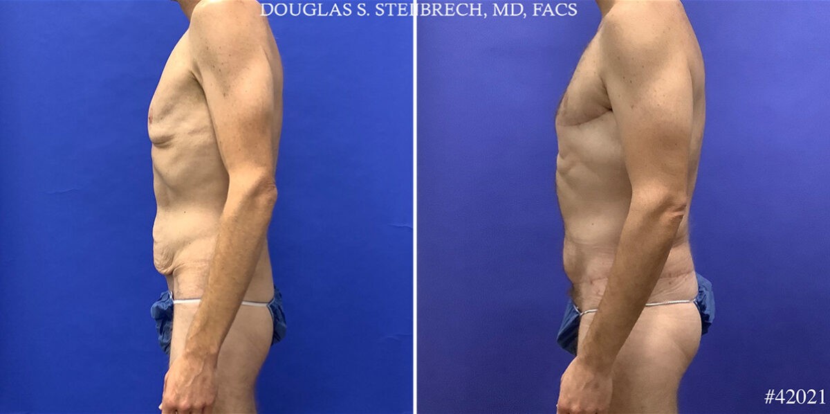 Patient 24833, Torso Tuck Before and After Photos Torso Tuck Before and After Photos in CA, Beverly Hills, Patient 24833