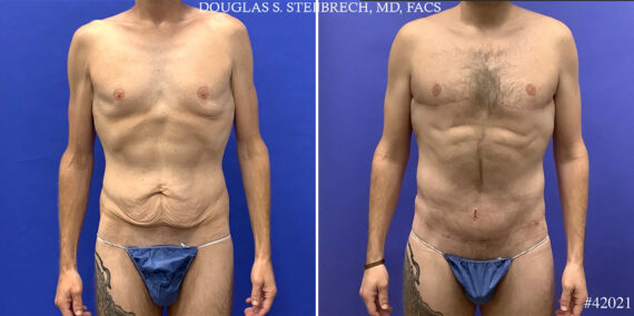Chest Lift Before and After Photos in CA, Beverly Hills, Patient 24833