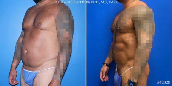 Torso Tuck Before and After Photos in CA, Beverly Hills, Patient 24843