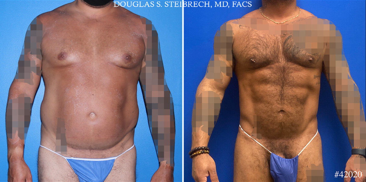 Patient 24843, Torso Tuck Before and After Photos Torso Tuck Before and After Photos in CA, Beverly Hills, Patient 24843