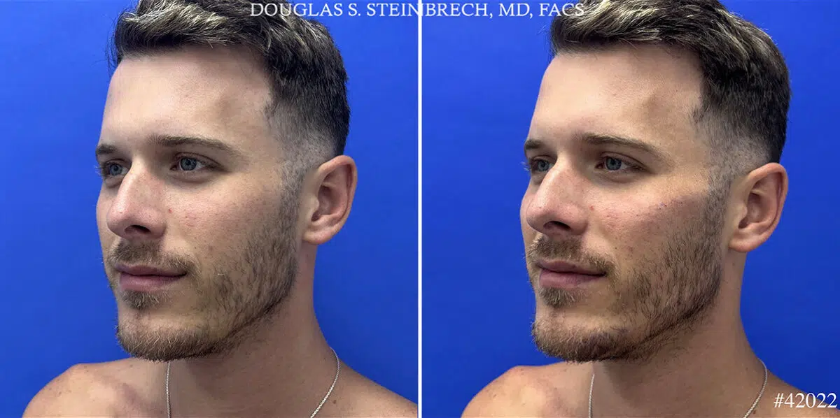Male Model Make Over Before and After Photos in CA, Beverly Hills, Patient 24948