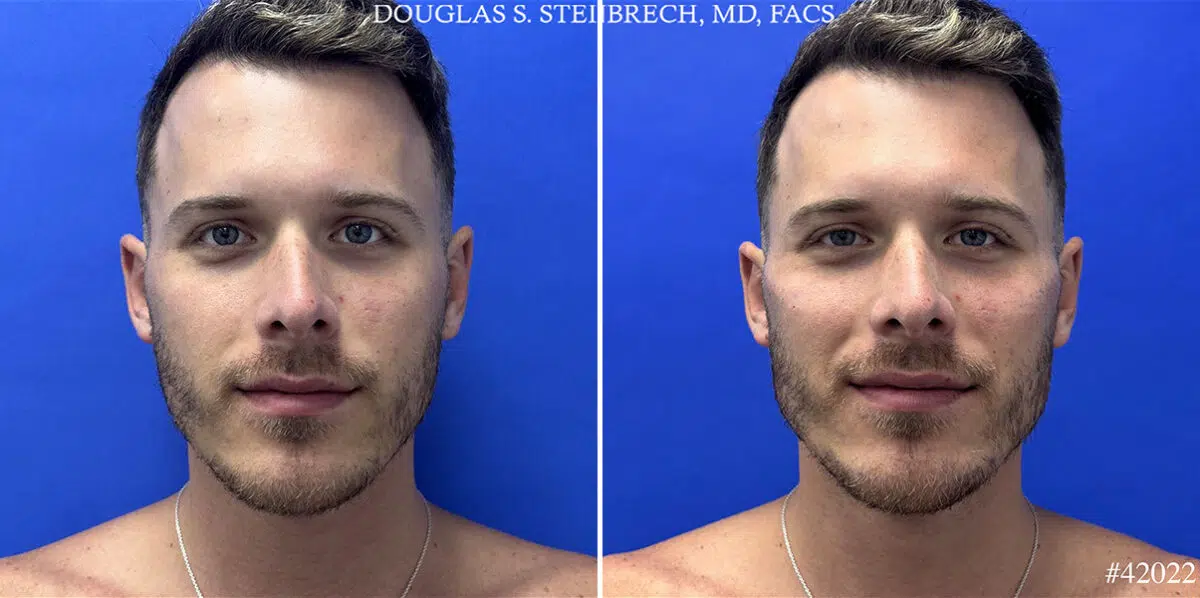 Male Model Make Over Before and After Photos in CA, Beverly Hills, Patient 24948