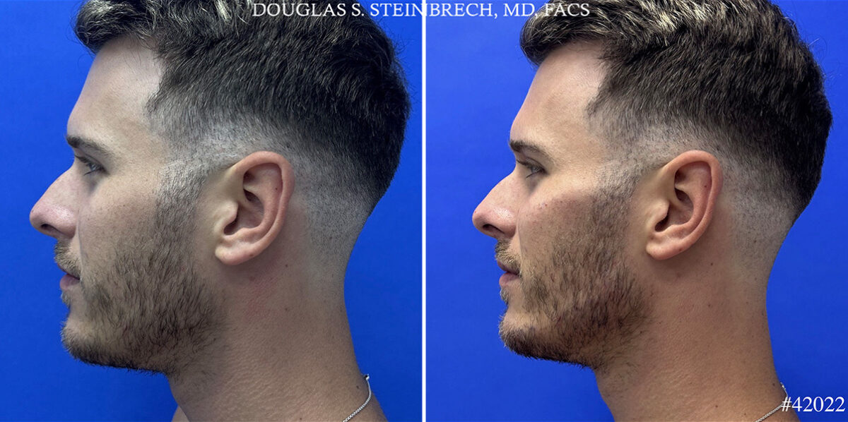 Male Model Make Over Before and After Photos in CA, Beverly Hills, Patient 24948