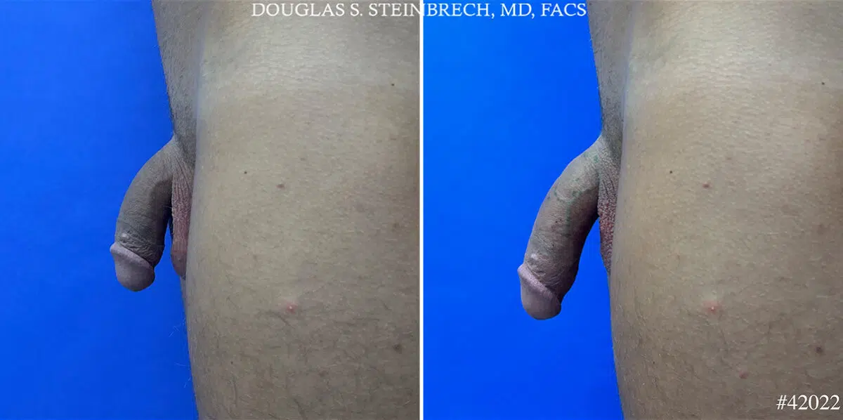 Patient 24970, Male Enhancement Before and After Photos Male Enhancement Before and After Photos in CA, Beverly Hills, Patient 24970