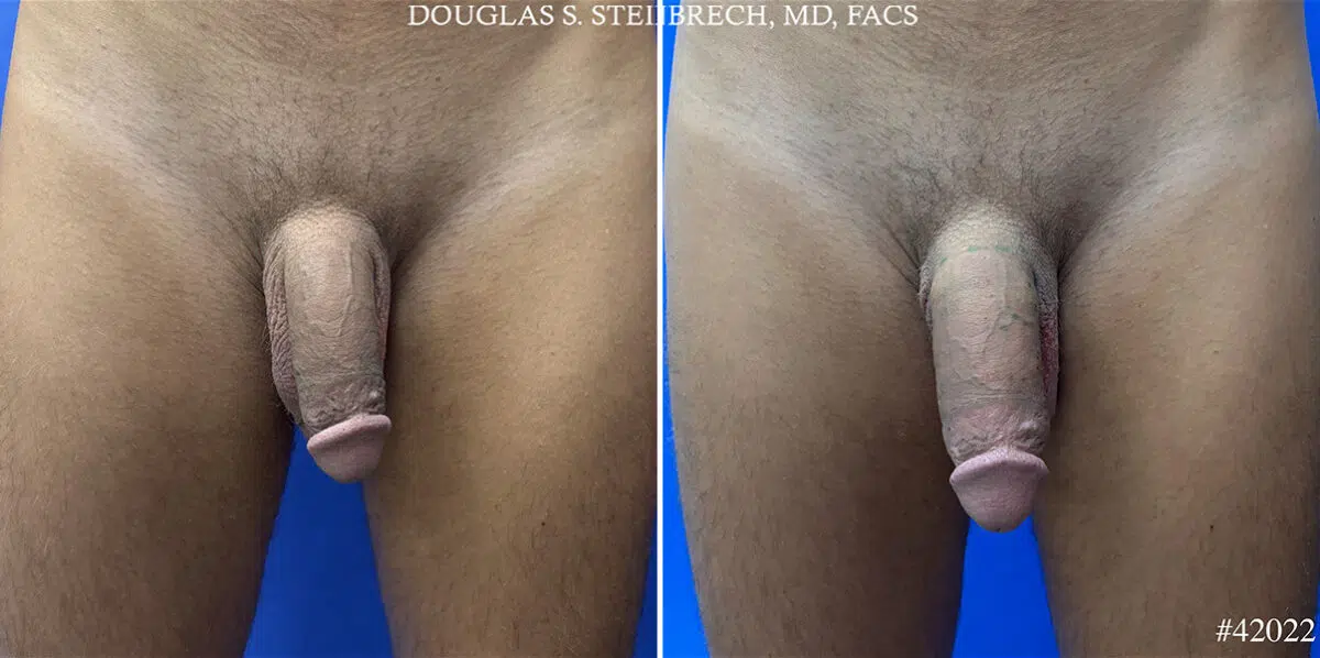 Patient 24970, Male Enhancement Before and After Photos Male Enhancement Before and After Photos in CA, Beverly Hills, Patient 24970