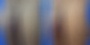 Male Enhancement Before and After Photos in CA, Beverly Hills, Patient 24970