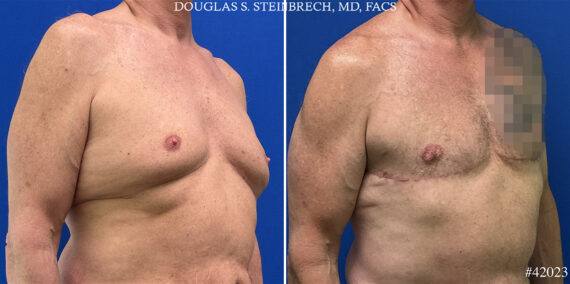 Body Banking Before and After Photos in CA, Beverly Hills, Patient 24974