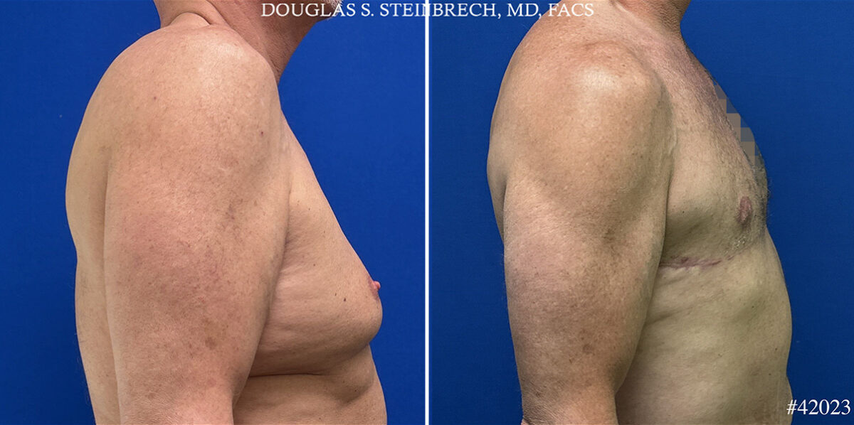 Patient 24974, Body Banking Before and After Photos Body Banking Before and After Photos in CA, Beverly Hills, Patient 24974