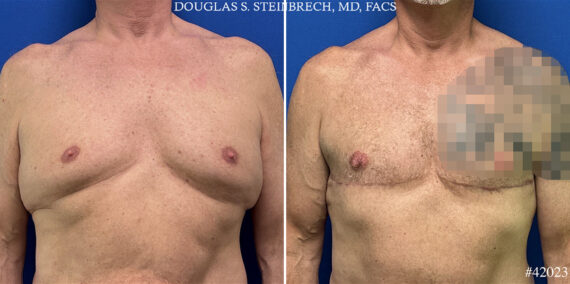 Body Banking Before and After Photos in CA, Beverly Hills, Patient 24974