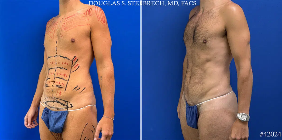 Patient 24989, Body Banking Before and After Photos Body Banking Before and After Photos in CA, Beverly Hills, Patient 24989