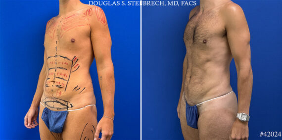 Body Banking Before and After Photos in CA, Beverly Hills, Patient 24989