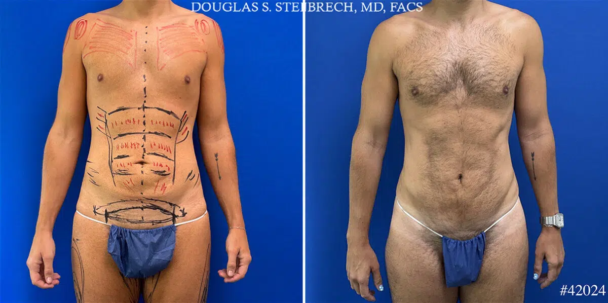 Patient 24989, Body Banking Before and After Photos Body Banking Before and After Photos in CA, Beverly Hills, Patient 24989