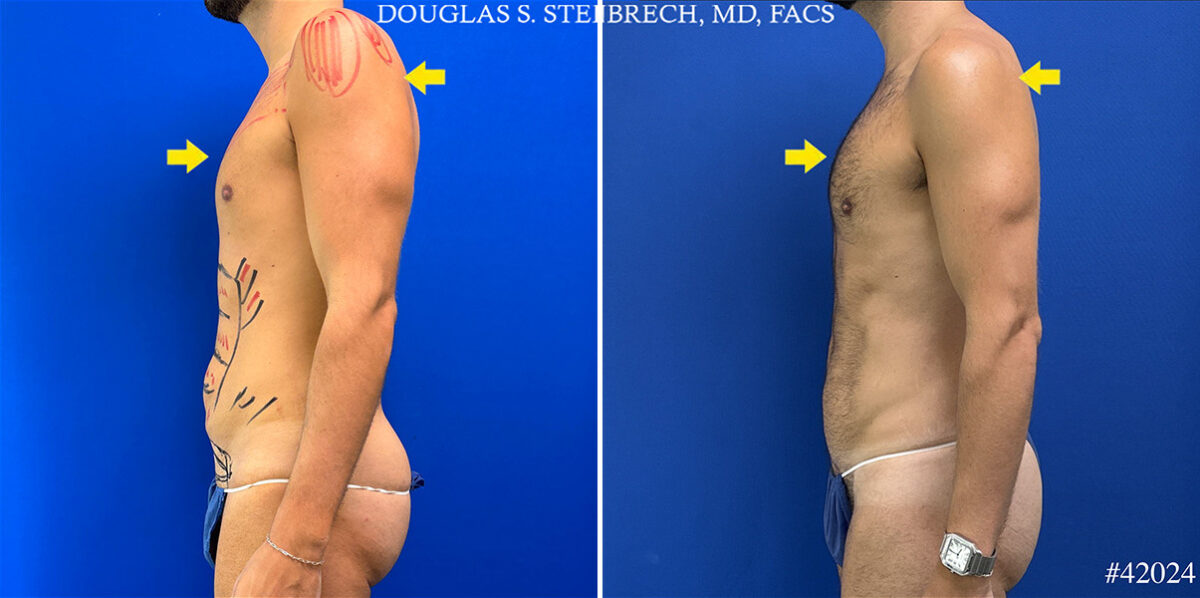 Patient 24989, Body Banking Before and After Photos Body Banking Before and After Photos in CA, Beverly Hills, Patient 24989
