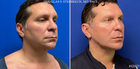 Chin Implant Before and After Photos in CA, Beverly Hills, Patient 24999