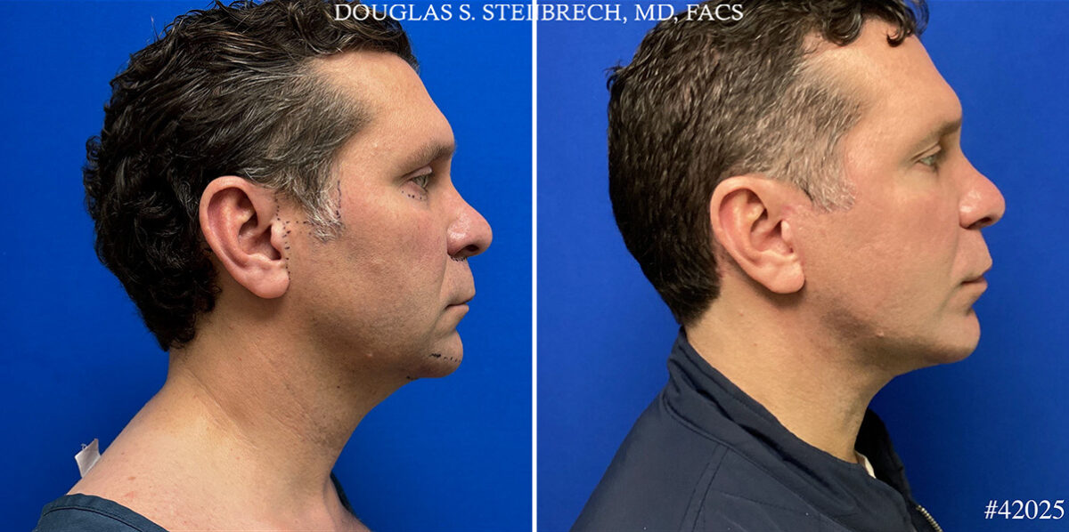 Chin Implant Before and After Photos in CA, Beverly Hills, Patient 24999
